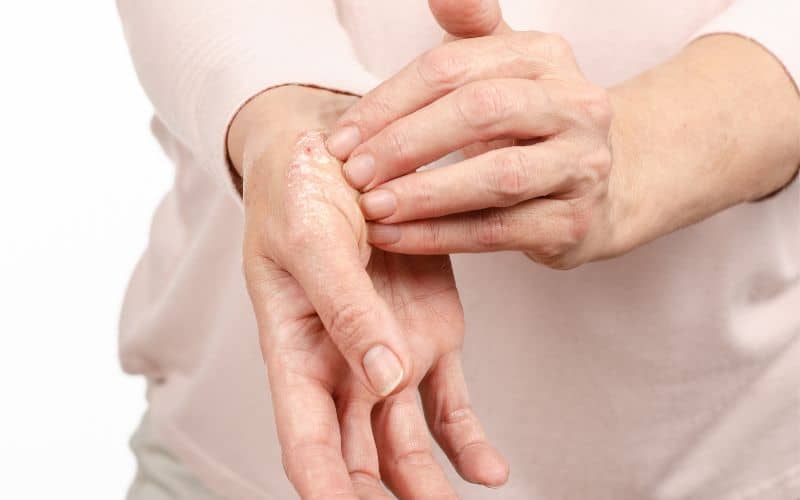 Photo showing a hand scratching another hand with some rashes